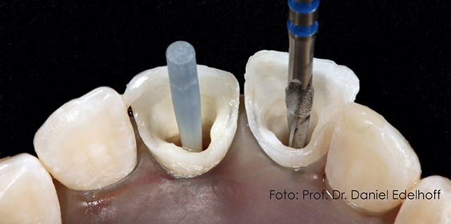 Prof. Dr. Daniel Edelhoff: Prothetische Versorgung: Komplexe prothetische Versorgungen unter Einbezug endodontisch versorgter Zähne