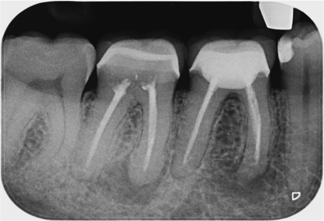 Dr. Josef Diemer: REVISION: Die endodontische Revisionsbehandlung – Kriterien der optimalen Fallselektion als Schlüssel zum Erfolg