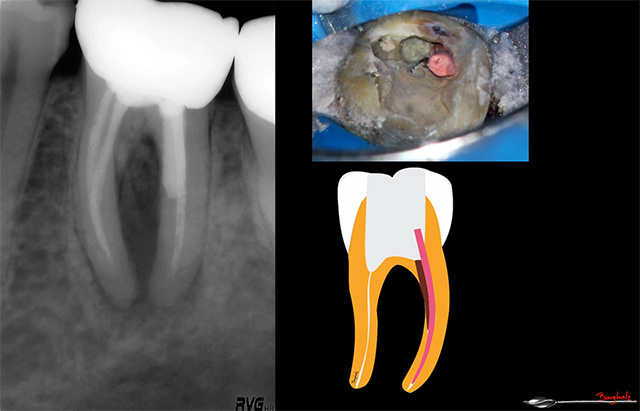 Dr. Clemens Bargholz: PROBLEMLÖSUNG: Lösung von Problemfällen in der Endodontie - Von der akuten Schmerztherapie bis zur Deckung einer Perforation