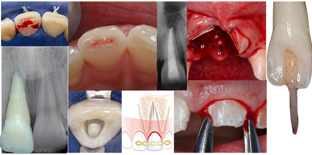Prof. Dr. Gabriel Krastl: TRAUMA: Erhalt und Versorgung traumatisch geschädigter Zähne