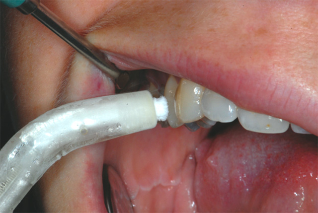 PD Dr. Dan Rechenberg: DIAGNOSTIK: Einsatz moderner, praxistauglicher Verfahren in der Diagnostik pulpitischer Zähne